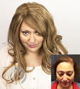 Female Hair Loss Treatment Options - Pittsburgh, PA