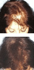 Female Laser Hair Loss Treatment - Pittsburgh, PA