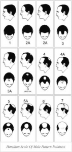 Hamilton Scale - Male Pattern Baldness